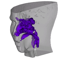 velopharyngeal